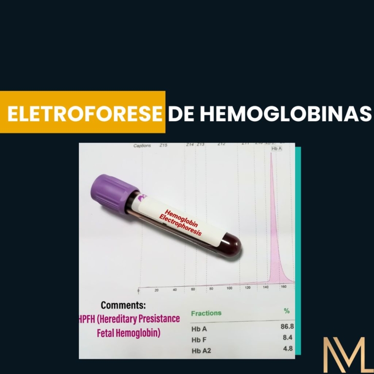 Eletroforese De Hemoglobinas Diagn Stico De Hemoglobinopatias Inml