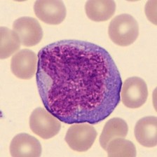 Hemograma na Mononucleose