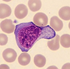 Hemograma na Mononucleose