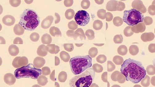 Hemograma na Mononucleose