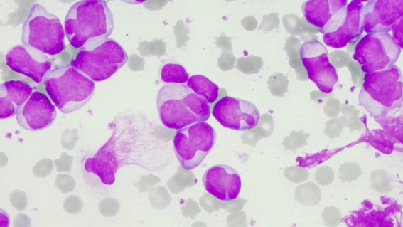 Leucemia promielocítica aguda