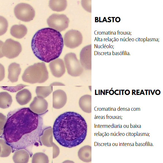 linfócito reativo e blasto