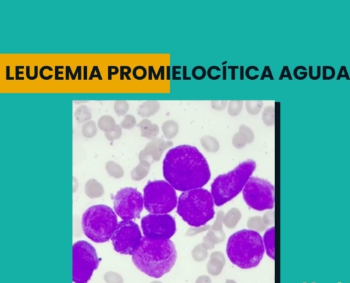 Leucemia Promielocítica Aguda