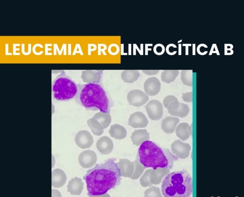 Leucemia prolinfocítica B