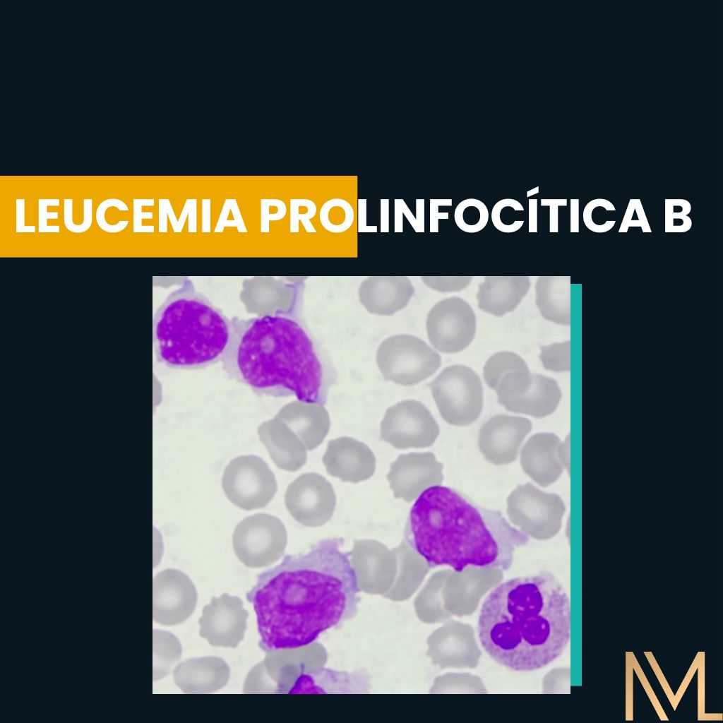 Leucemia Prolinfocítica B: Nova Nomenclatura E Atualização Da OMS - INML