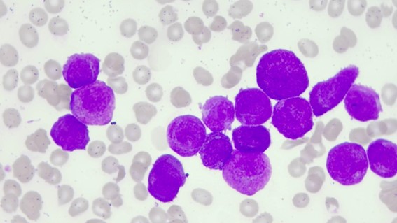 Leucemia promielocítica aguda