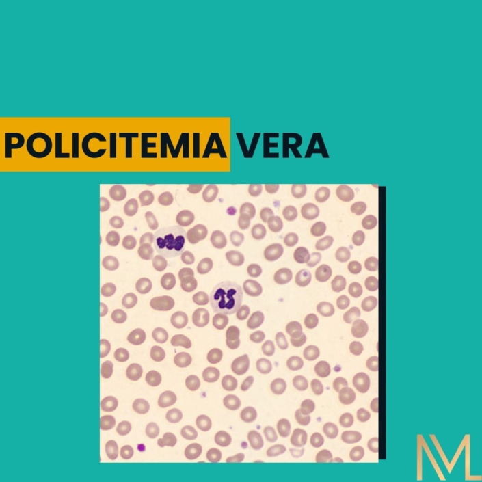 Causas Y Tipos De Policitemia Vera – RHXRZI