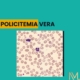 Policitemia Vera