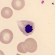 beta talassemia