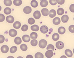 beta talassemia