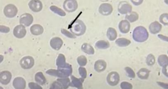 hemoglobinopatias