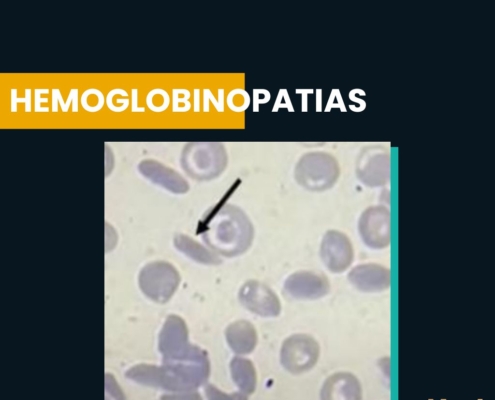 Hemoglobinopatias