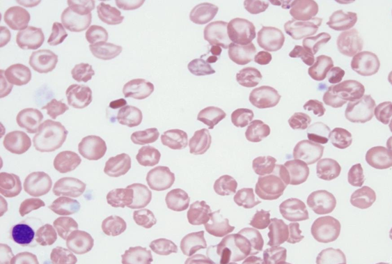 hemoglobinopatias