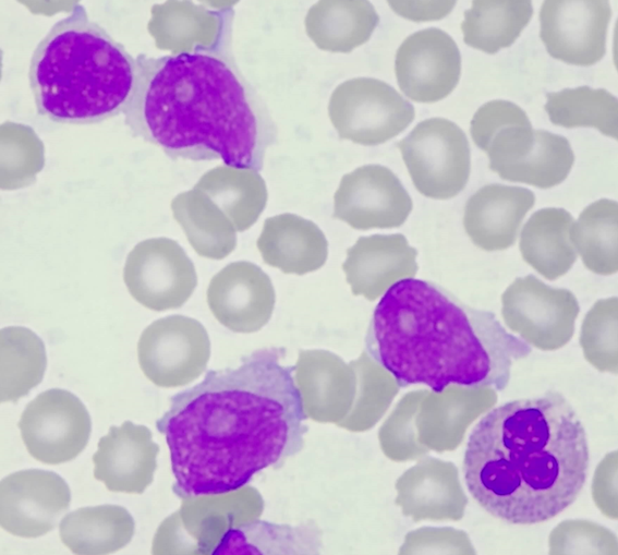 leucemia prolinfocítica B