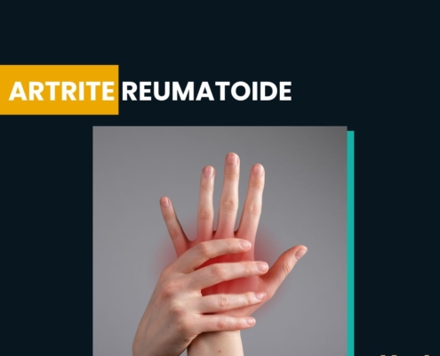 Artrite Reumatoide