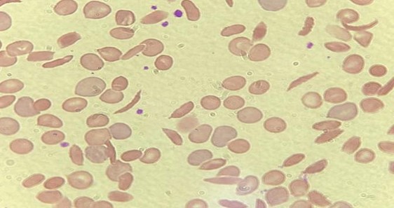 hemograma na anemia falciforme