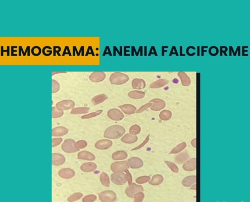 Hemograma na anemia falciforme
