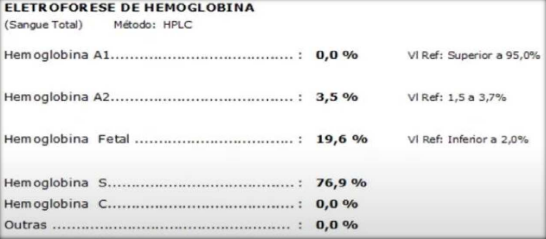 hemograma na anemia falciforme 