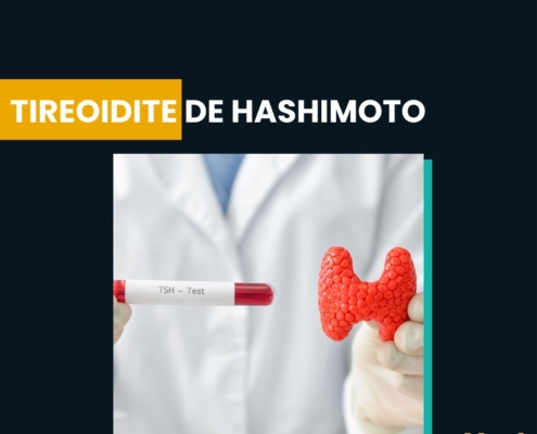 tireoidite de hashimoto