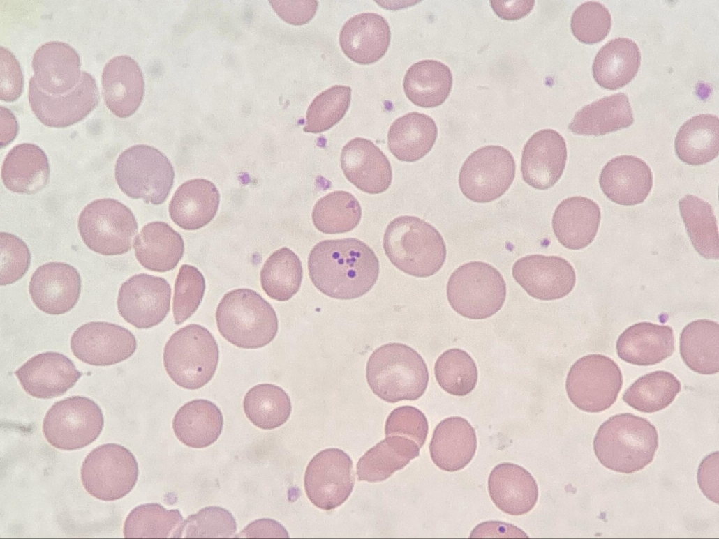 anemia