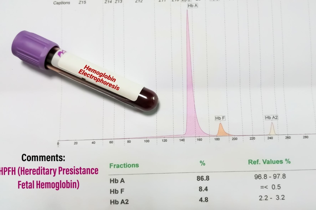 Eletroforese de Hemoglobinas