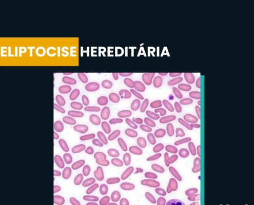 ELIPTOCITOSE HEREDITÁRIA