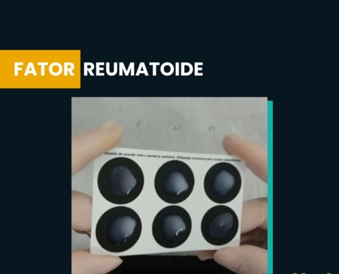 fator reumatoide