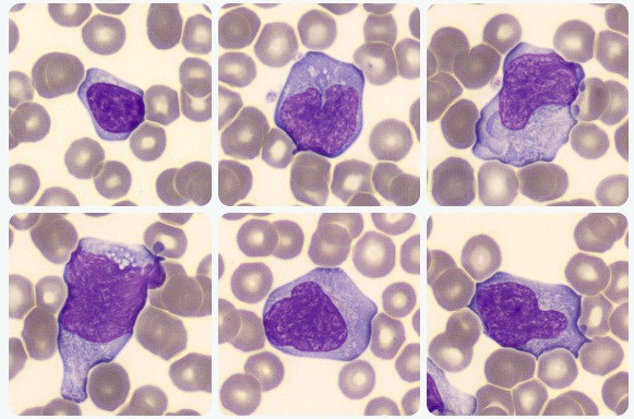 mononucleose infecciosa