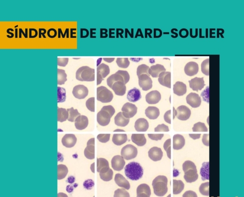 síndrome de Bernard-Soulier