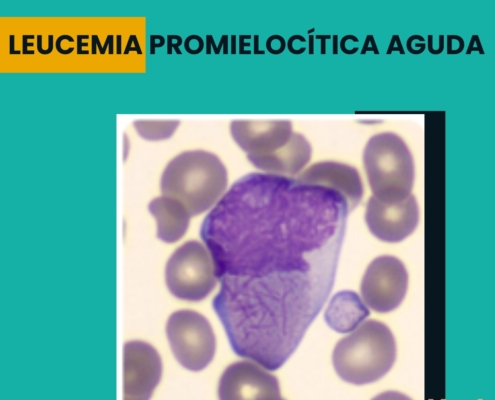 leucemia promielocítica aguda