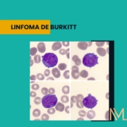 linfoma de Burkitt