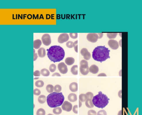 linfoma de Burkitt