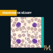 síndrome de Sézary