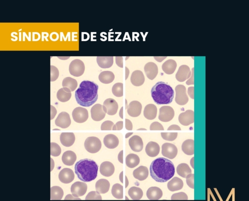 síndrome de Sézary