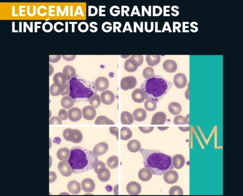 leucemia de grandes linfócitos granulares