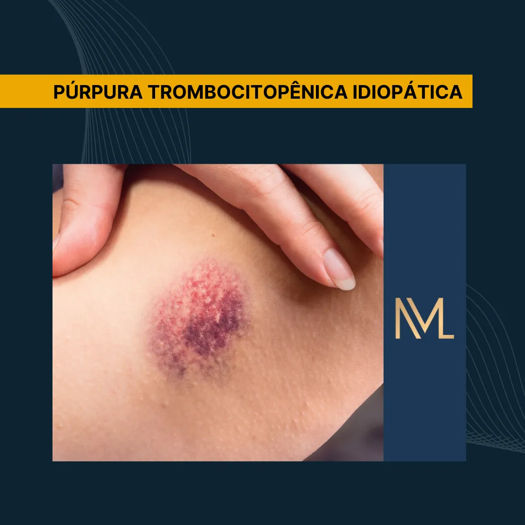 Histologia Da Purpura Trombocitopenica Idiopatica Púrpura
