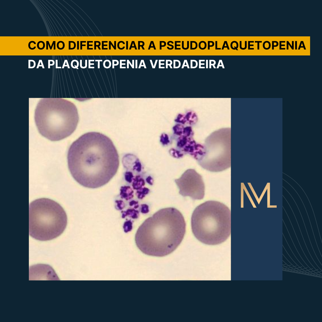 Diferenças entre pseudoplaquetopenia e plaquetopenia verdadeira - INML