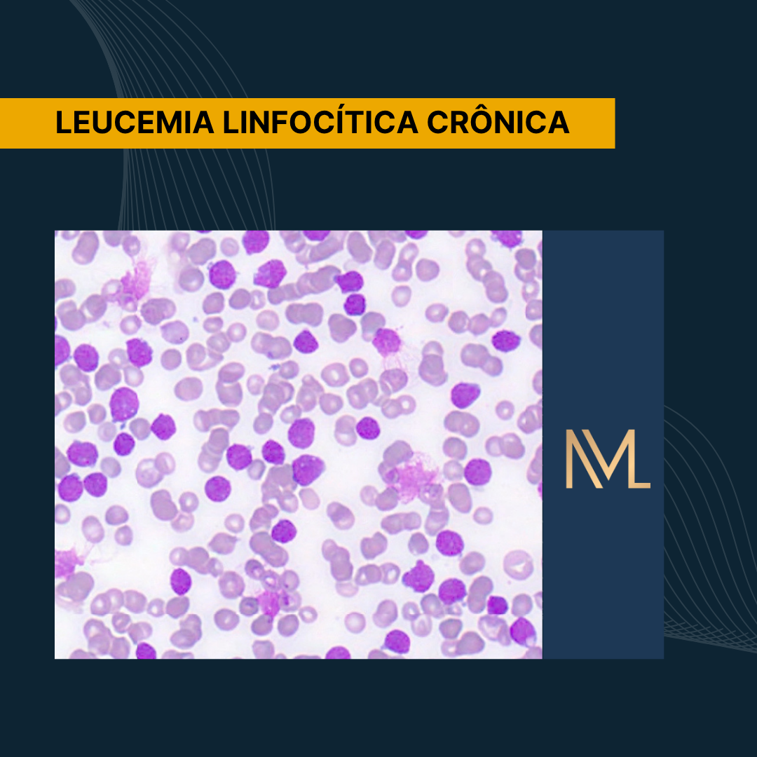 Leucemia Linfocítica Crônica - INML